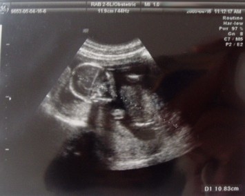 妊娠中期 16w 22w 帝王切開 前置胎盤 体験記
