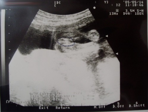 w4d 超音波写真 女の子 性別判明の瞬間 帝王切開 前置胎盤 体験記