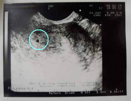妊娠初期 4w 8w 帝王切開 前置胎盤 体験記